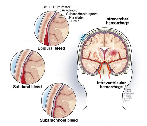 scheminė epidurinės hematomos iliustracija