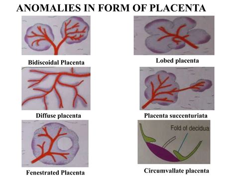 Schematinis paveikslėlis, rodantis įvairius placentos anomalijų tipus, įskaitant placenta succenturiata