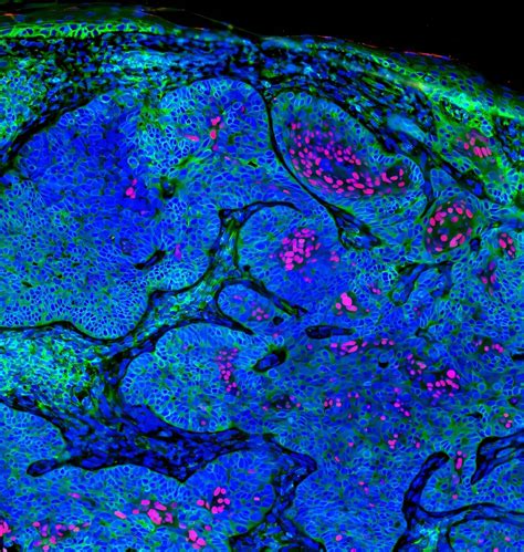 Aiškios ląstelės inkstų ląstelių karcinomos mikroskopinis vaizdas