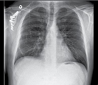 Krūtinės ląstos rentgenograma su poodine emfizema
