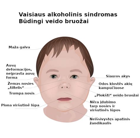 Veido bruožai, būdingi Dauno sindromui