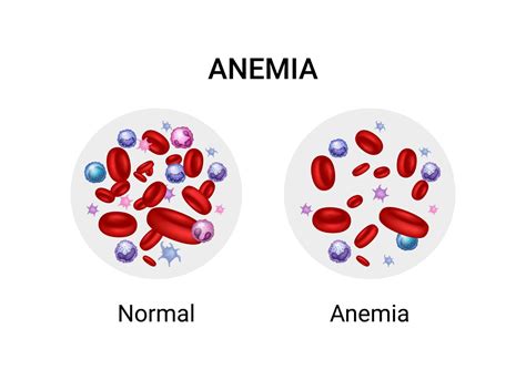 simptomai, susiję su anemija