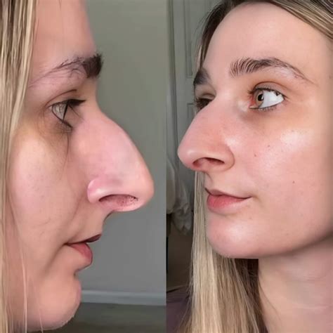 nėščia moteris su nosies užgulimu