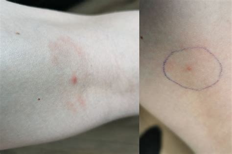 motininė dėmė ant odos