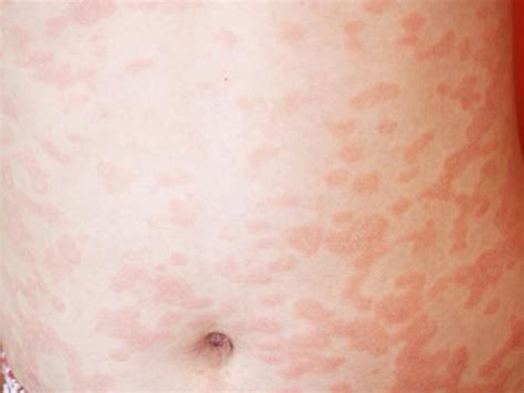 išplitusi rožinė dedervinė ant liemens