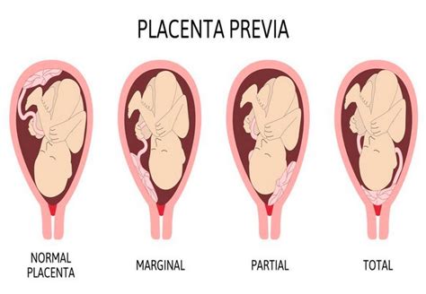 Kūdikio, besinaudojančio dirbtine placenta, iliustracija