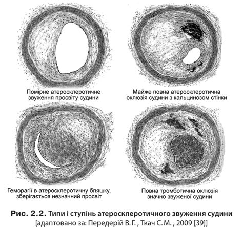 Гістологічне зображення тромбу в пуповинній артерії