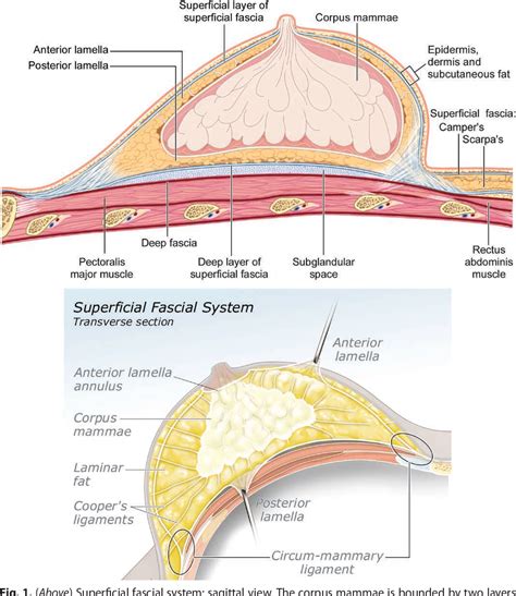 Anatomical diagram showing placement of breast implants under muscle