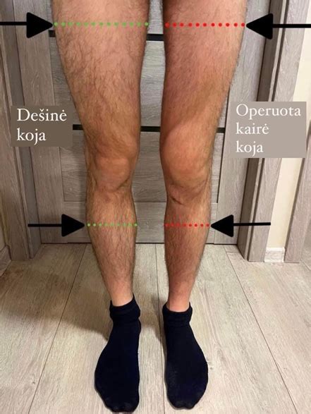 kojų tinimas po operacijos