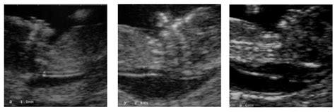 vaisiaus kaklo raukšlės matavimas ultragarsu