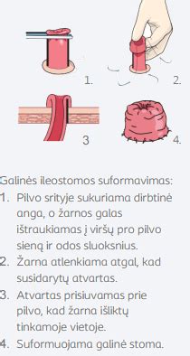 schematinis tiesiosios žarnos įterpimas