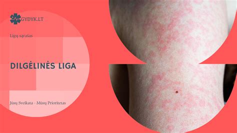 Infografika: Dilgėlinės tipai ir priežastys