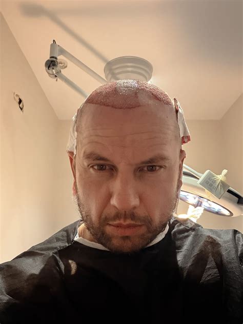 Infografika, lyginanti skirtingus plaukų persodinimo metodus