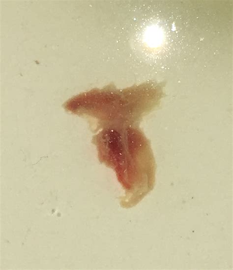 Image showing the appearance of mucus plug discharge with slight blood streaks