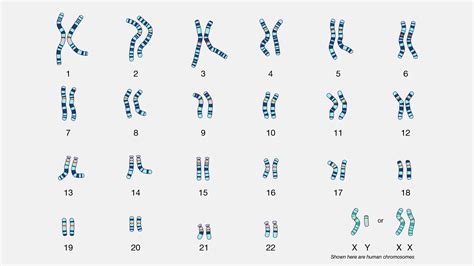 Žmogaus kariotipo iliustracija, rodanti tris 21-ąsias chromosomas