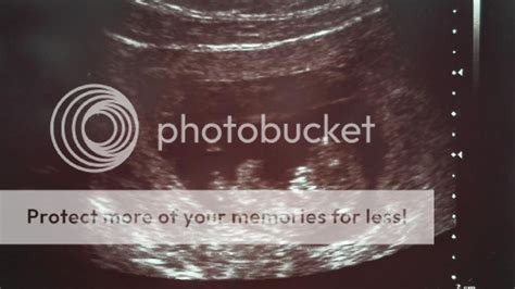 Vaisiaus vystymasis ultragarsu