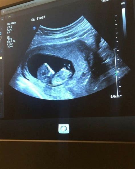 Kūdikio judesiai ultragarsu