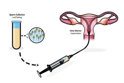 Donorinė sperma atliekant IUI procedūrą