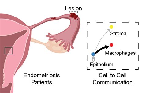 Endometriozės gydymo schemos