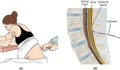 diagram showing needle placement in epidural space