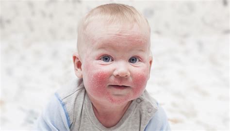 Vaiko oda su atopinio dermatito bėrimais