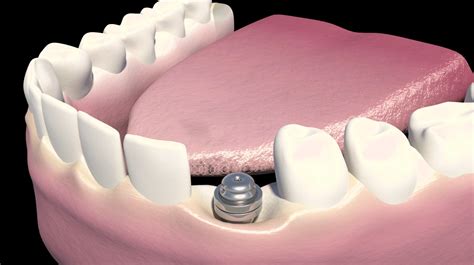 Danties implantas, įsuktas į žandikaulio kaulą