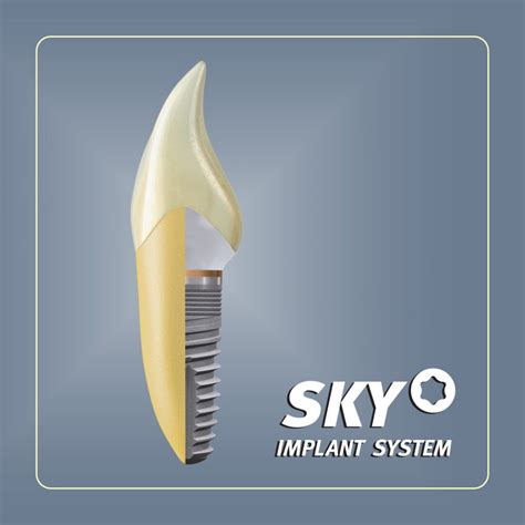 Osteointegracijos procesas: implanto susijungimas su kaulu