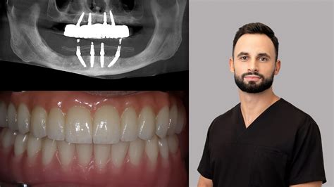 Senjoras, besidžiaugiantis šypsena po dantų implantacijos