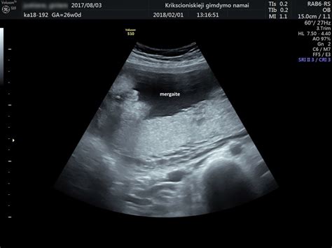 Ultragarsinis vaisiaus kaklo nugarinės raukšlės matavimas