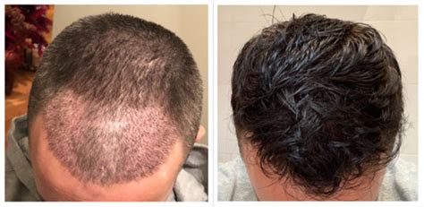 Scheminis plaukų persodinimo FUE metodo pavaizdavimas