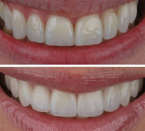 Prieš ir po „Hollywood Smile“ procedūros nuotrauka