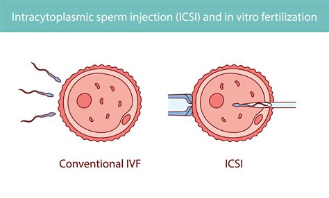 IVF procedūros schematinis pavaizdavimas
