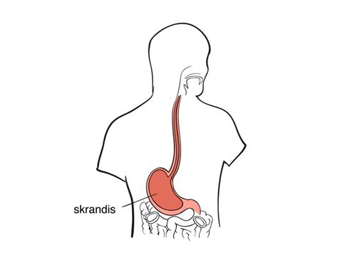 Stemplė ir skrandis su refliukso schema