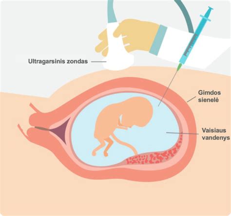 Medicininė adata ir vaisiaus vandenų mėginys