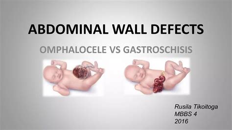 pilvo sienelės defektų palyginimas (omphalocele vs gastroschisis)