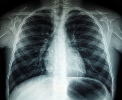 Plaučių audinio rentgeno nuotrauka, rodanti fibrozinius pokyčius