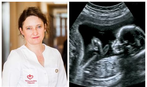 Vaisiaus echoskopija