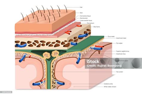 Anatomical diagram showing the layers of the meninges and the location of an epidural hematoma