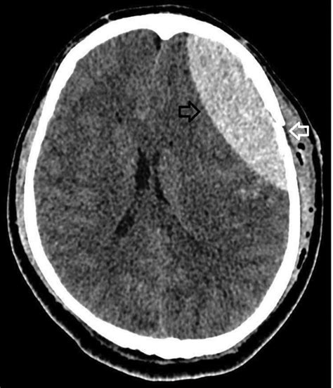 CT scan showing a biconvex epidural hematoma